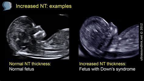 nuchal fold thickness measurement at 14 weeks|thick nuchal fold normal baby.